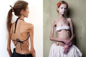 anoreksja-zaburzenie_odzywiania